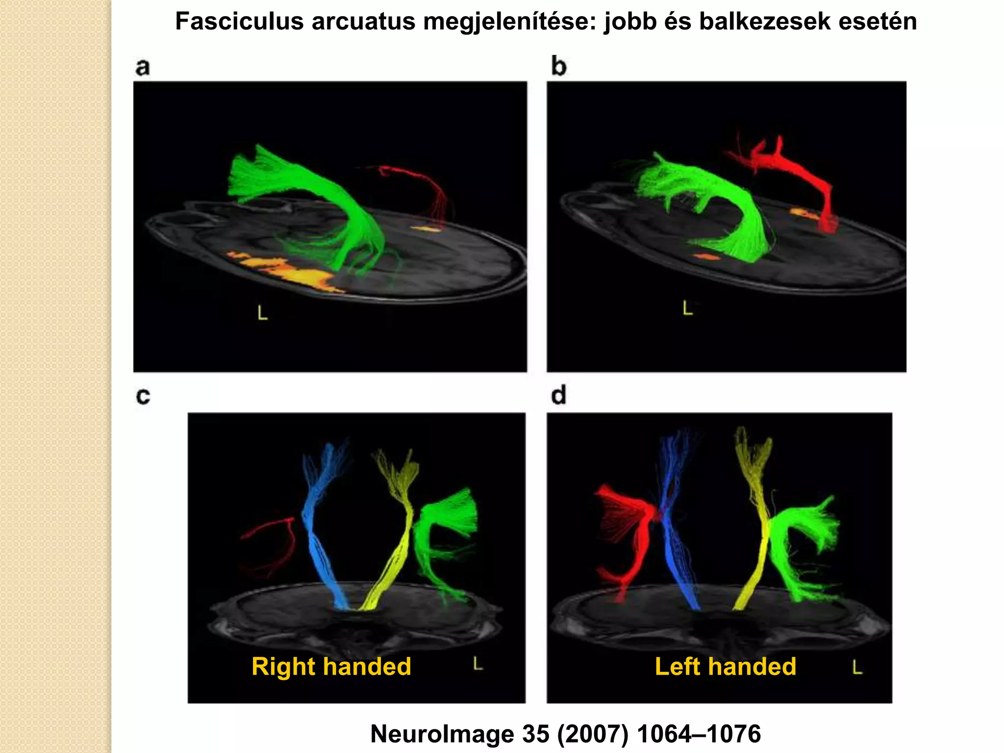 Right handed Left handed
NeuroImage 35 (2007) 1064–1076
Fasciculus arcuatus megjelenítése: jobb és balkezesek esetén
 