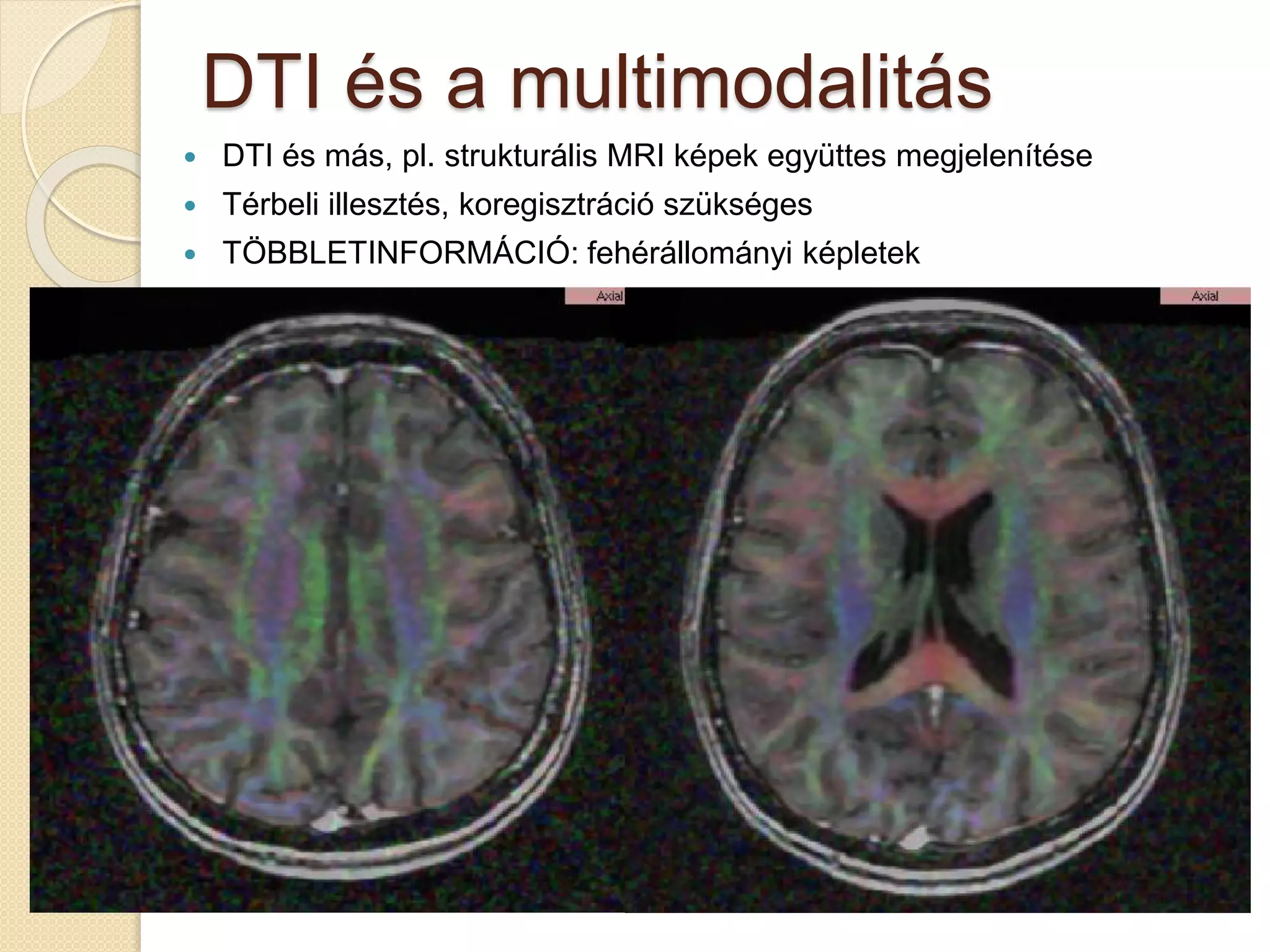 DTI és a multimodalitás
 DTI és más, pl. strukturális MRI képek együttes megjelenítése
 Térbeli illesztés, koregisztráció szükséges
 TÖBBLETINFORMÁCIÓ: fehérállományi képletek
 