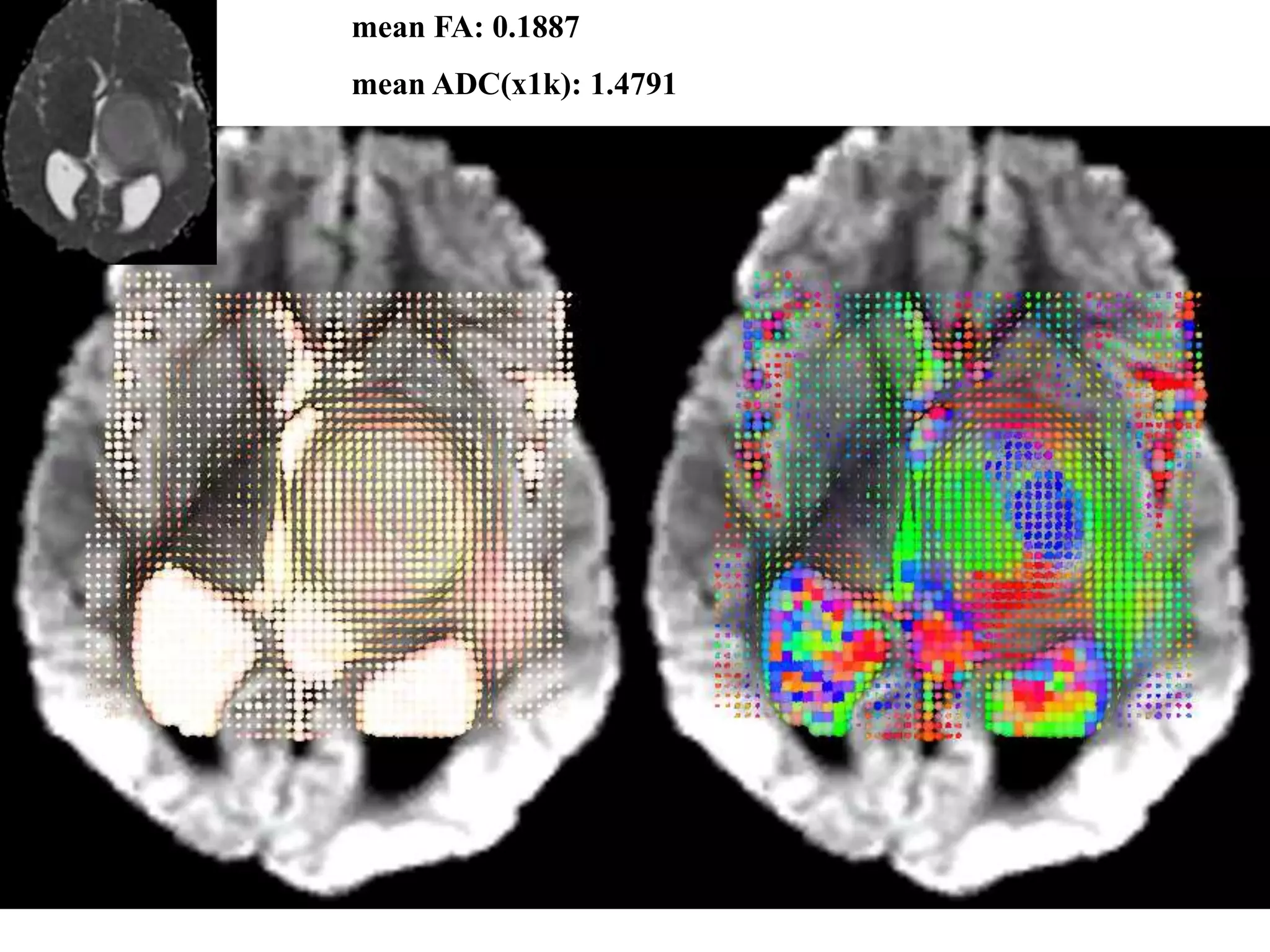 mean FA: 0.1887
mean ADC(x1k): 1.4791
 