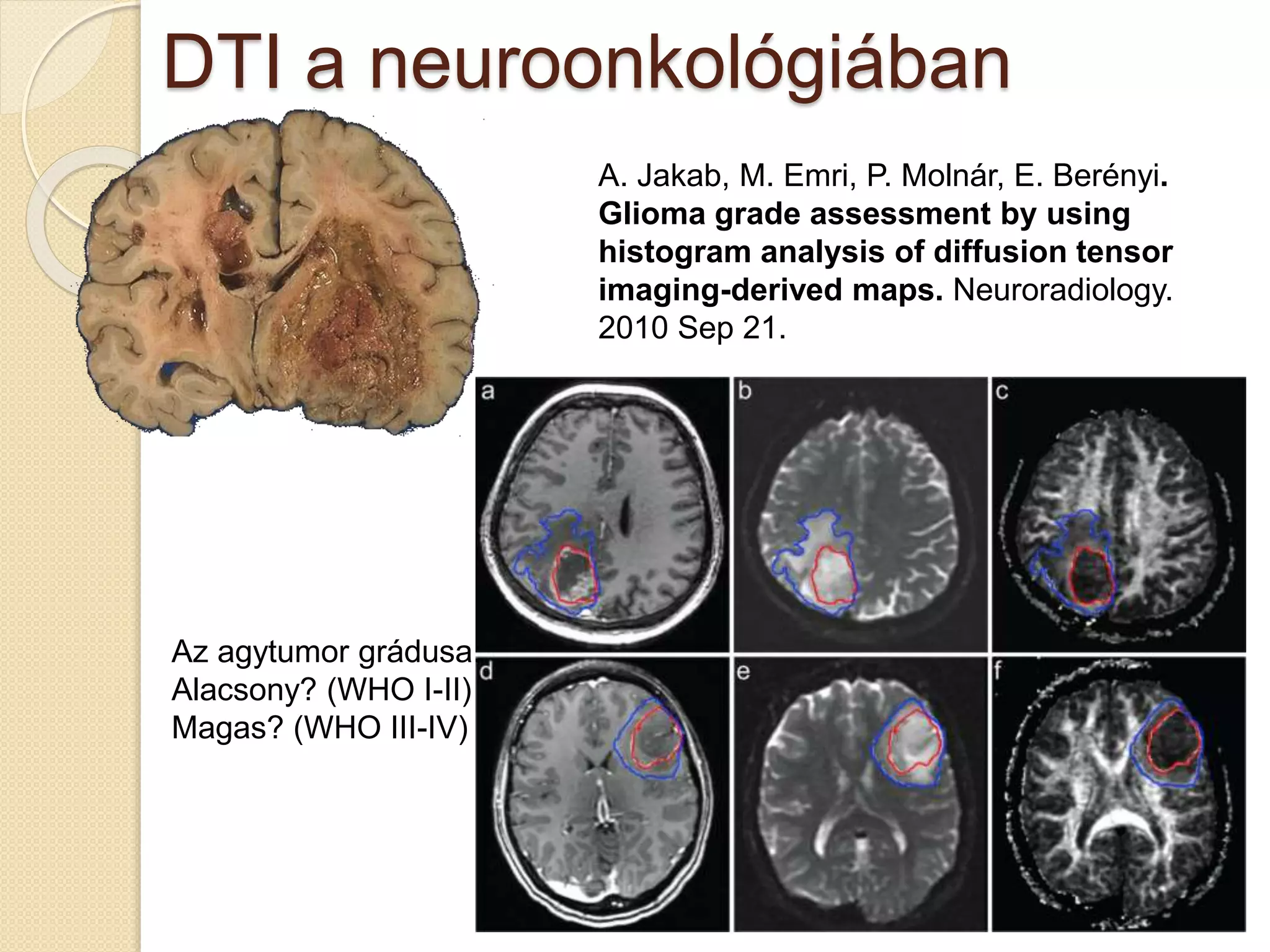 DTI a neuroonkológiában
A. Jakab, M. Emri, P. Molnár, E. Berényi.
Glioma grade assessment by using
histogram analysis of diffusion tensor
imaging-derived maps. Neuroradiology.
2010 Sep 21.
Az agytumor grádusa:
Alacsony? (WHO I-II)
Magas? (WHO III-IV)
 