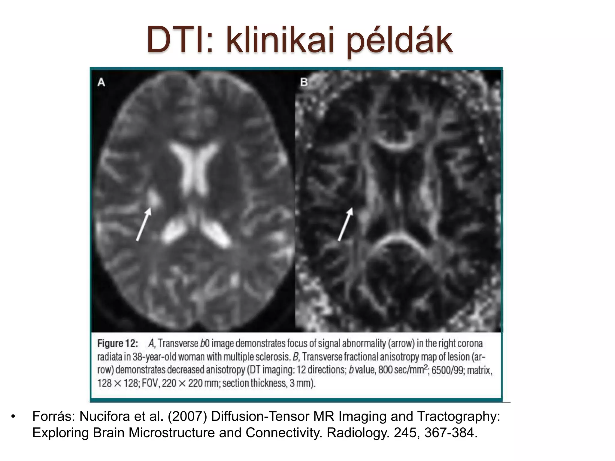 DTI: klinikai példák
• Forrás: Nucifora et al. (2007) Diffusion-Tensor MR Imaging and Tractography:
Exploring Brain Microstructure and Connectivity. Radiology. 245, 367-384.
 