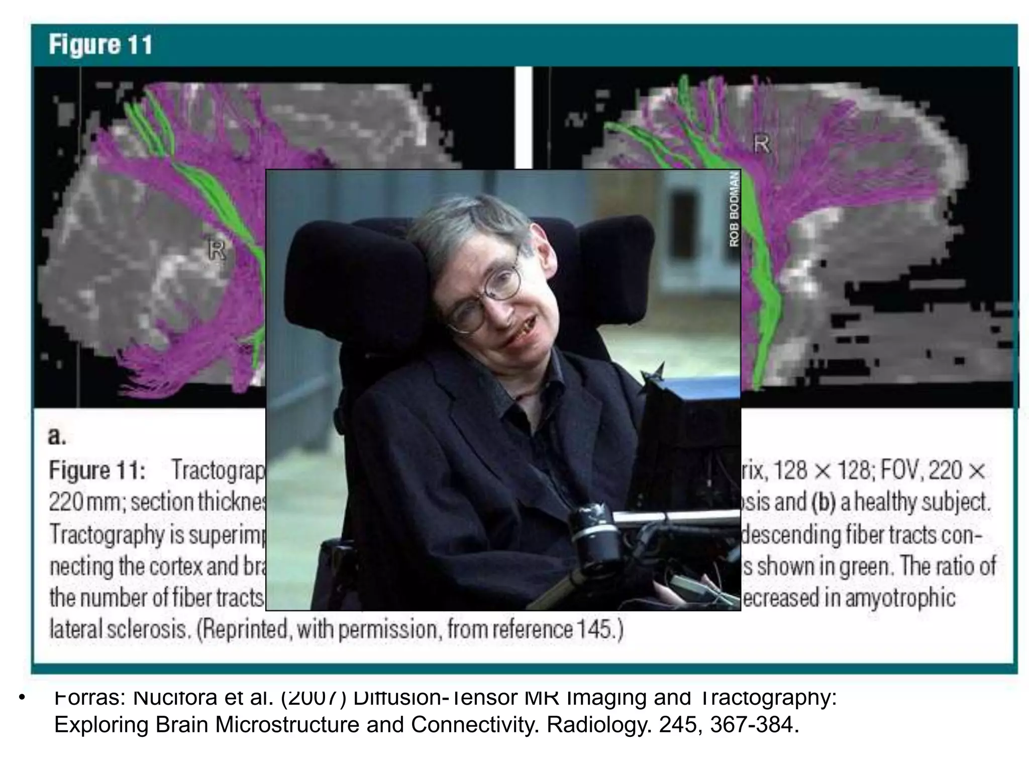• Forrás: Nucifora et al. (2007) Diffusion-Tensor MR Imaging and Tractography:
Exploring Brain Microstructure and Connectivity. Radiology. 245, 367-384.
 