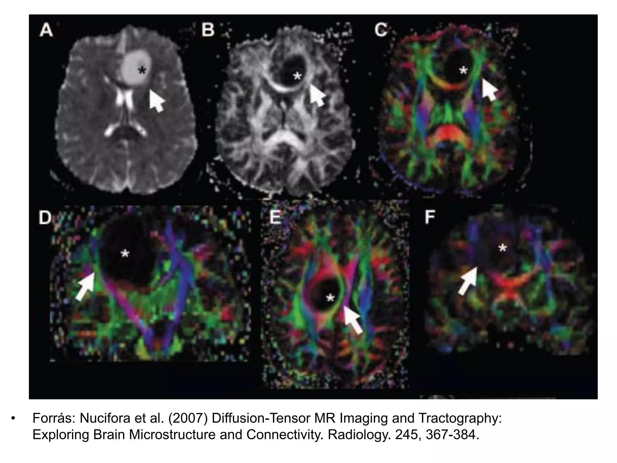 • Forrás: Nucifora et al. (2007) Diffusion-Tensor MR Imaging and Tractography:
Exploring Brain Microstructure and Connectivity. Radiology. 245, 367-384.
 