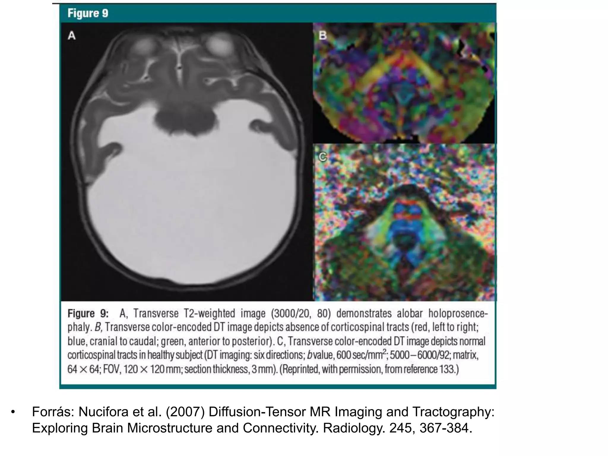• Forrás: Nucifora et al. (2007) Diffusion-Tensor MR Imaging and Tractography:
Exploring Brain Microstructure and Connectivity. Radiology. 245, 367-384.
 
