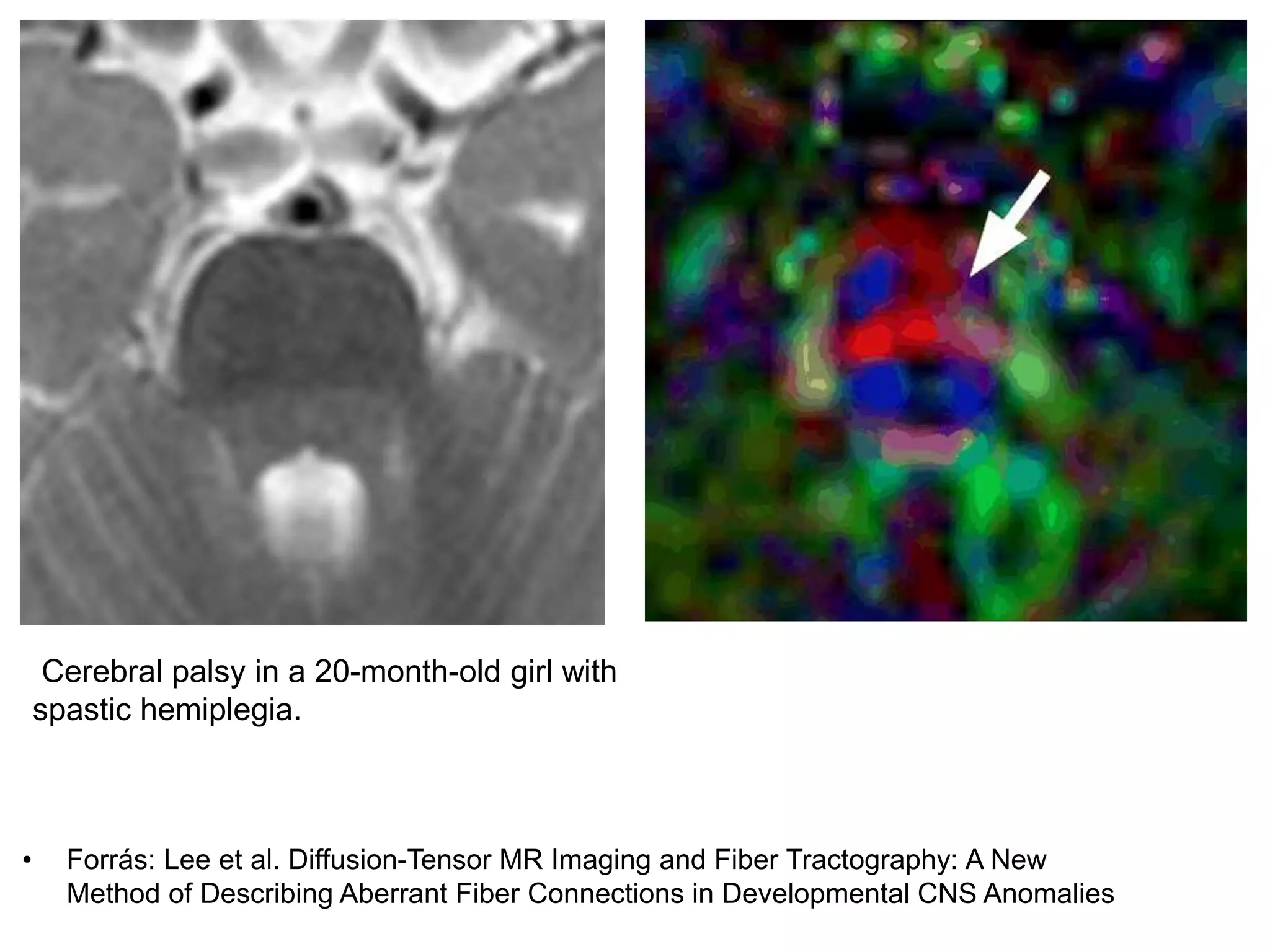 • Forrás: Lee et al. Diffusion-Tensor MR Imaging and Fiber Tractography: A New
Method of Describing Aberrant Fiber Connections in Developmental CNS Anomalies
Cerebral palsy in a 20-month-old girl with
spastic hemiplegia.
 