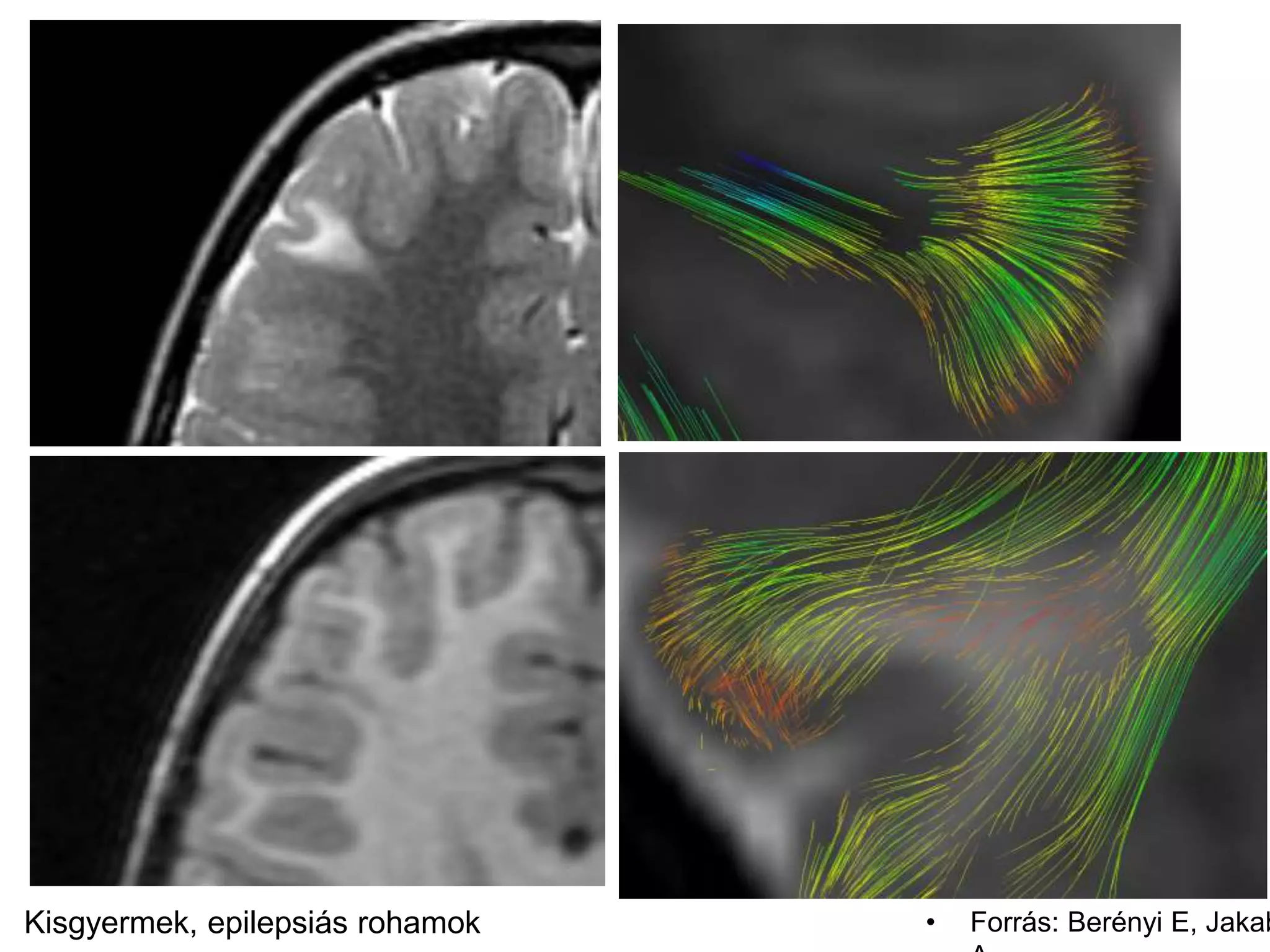 • Forrás: Berényi E, JakabKisgyermek, epilepsiás rohamok
 