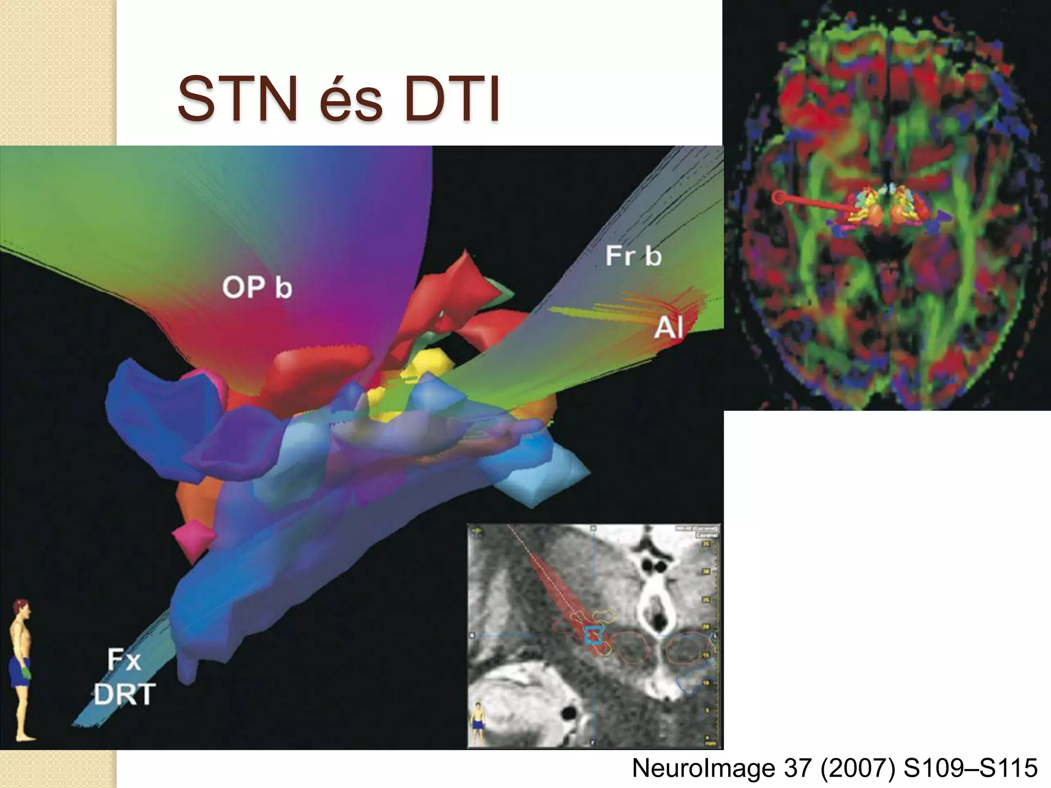 NeuroImage 37 (2007) S109–S115
STN és DTI
 