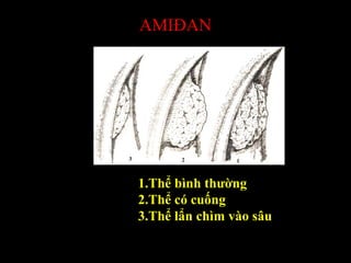 AMIĐAN
1.Thể bình thường
2.Thể có cuống
3.Thể lẩn chìm vào sâu
 