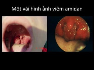 Một vài hình ảnh viêm amidan
 