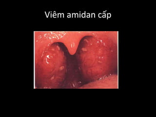 Viêm amidan cấp
 