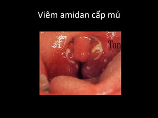 Viêm amidan cấp mủ
 