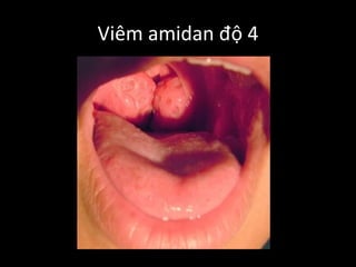 Viêm amidan độ 4
 