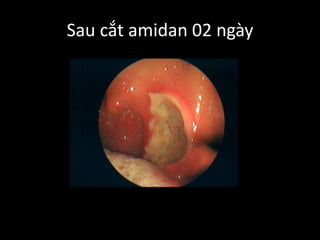 Sau cắt amidan 02 ngày
 