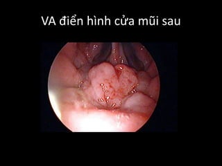 VA điển hình cửa mũi sau
 