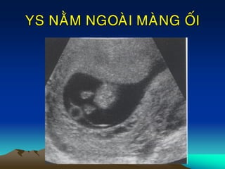 YS NAÈM NGOAØI MAØNG OÁI
 