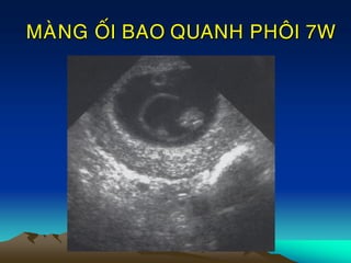 MAØNG OÁI BAO QUANH PHOÂI 7W
 