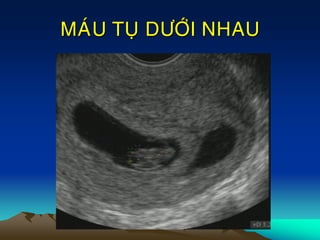 MAÙU TUÏ DÖÔÙI NHAU
 