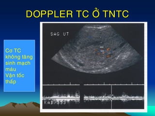 DOPPLER TC ÔÛ TNTC
Cô TC
khoâng taêng
sinh maïch
maùu
Vaän toác
thaáp
 