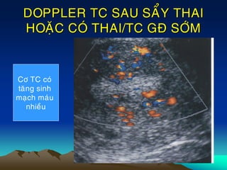 DOPPLER TC SAU SAÅY THAI
HOAËC COÙ THAI/TC GÑ SÔÙM
Cô TC coù
taêng sinh
maïch maùu
nhieàu
 