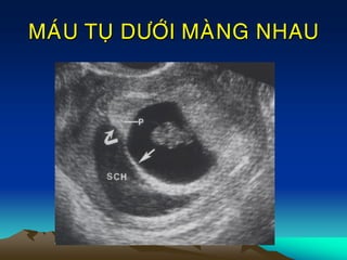 MAÙU TUÏ DÖÔÙI MAØNG NHAU
 