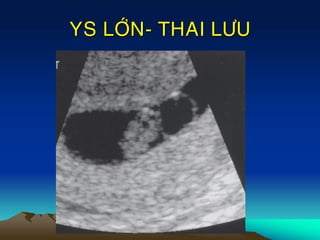 YS LÔÙN- THAI LÖU
 