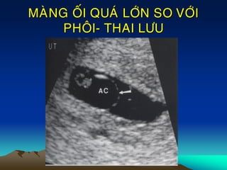 MAØNG OÁI QUAÙ LÔÙN SO VÔÙI
PHOÂI- THAI LÖU
 