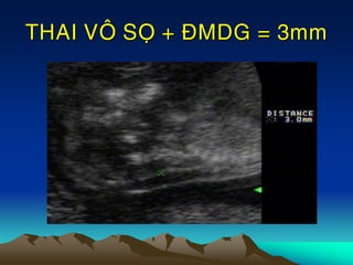THAI VOÂ SOÏ + ÑMDG = 3mm
 