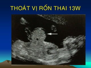 THOAÙT VÒ ROÁN THAI 13W
 