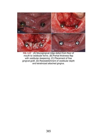 Flaring Ridge Defect 1, Klasifikasi Newman and Carranza's Clinical Periodontology E-Book.pdf