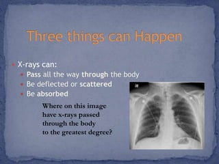  X-rays can: 
 Pass all the way through the body 
 Be deflected or scattered 
 Be absorbed 
Where on this image 
have x-rays passed 
through the body 
to the greatest degree? 
 
