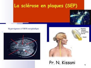1
La sclérose en plaques (SEP)
Pr. N. Kissani
Hypersignaux à l’IRM encéphalique
 