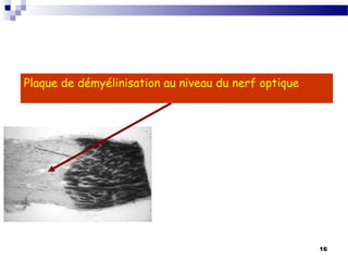 16
Plaque de démyélinisation au niveau du nerf optique
 