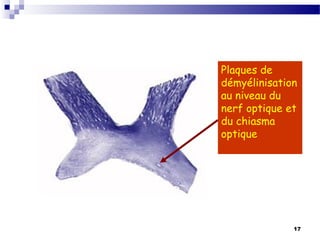 17
Plaques de
démyélinisation
au niveau du
nerf optique et
du chiasma
optique
 