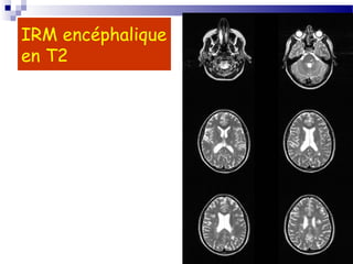 28
IRM encéphalique
en T2
 