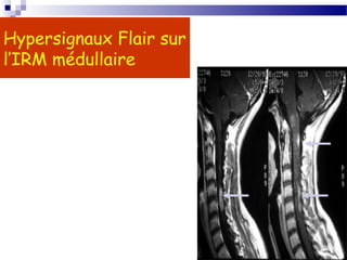 29
Hypersignaux Flair sur
l’IRM médullaire
 