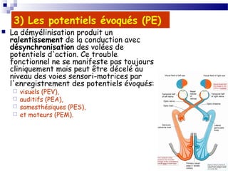33
3) Les potentiels évoqués (PE)
 La démyélinisation produit un
ralentissement de la conduction avec
désynchronisation des volées de
potentiels d'action. Ce trouble
fonctionnel ne se manifeste pas toujours
cliniquement mais peut être décelé au
niveau des voies sensori-motrices par
l'enregistrement des potentiels évoqués:
 visuels (PEV),
 auditifs (PEA),
 somesthésiques (PES),
 et moteurs (PEM).
 