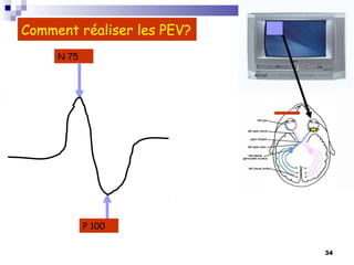 34
Comment réaliser les PEV?
P 100
N 75
 