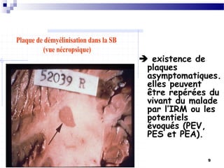 9
Plaque de démyélinisation dans la SB
(vue nécropsique)
 existence de
plaques
asymptomatiques.
elles peuvent
être repérées du
vivant du malade
par l’IRM ou les
potentiels
évoqués (PEV,
PES et PEA).
 