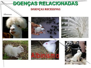 DOENÇAS RELACIONADASDOENÇAS RELACIONADAS
DOENÇAS RECESSIVASDOENÇAS RECESSIVAS
Albinismo
 