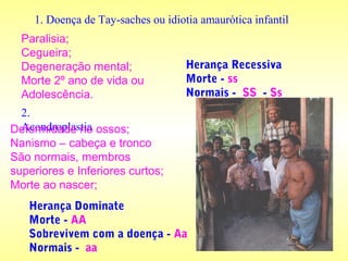 1. Doença de Tay-saches ou idiotia amaurótica infantil
Paralisia;
Cegueira;
Degeneração mental;
Morte 2º ano de vida ou
Adolescência.
Herança Recessiva
Morte - ss
Normais - SS - Ss
2.
AcondroplastiaDeformidade no ossos;
Nanismo – cabeça e tronco
São normais, membros
superiores e Inferiores curtos;
Morte ao nascer;
Herança Dominate
Morte - AA
Sobrevivem com a doença - Aa
Normais - aa
 