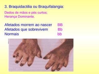 3. Braquidactilia ou Braquifalangia:
Dedos de mãos e pés curtos;
Herança Dominante.
Afetados morrem ao nascer BB
Afetados que sobrevivem Bb
Normais bb
 