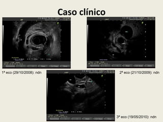 Caso clínico




1ª eco (29/10/2008): ndn                   2ª eco (21/10/2009): ndn




                                          3ª eco (19/05/2010): ndn
 