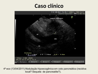 Caso clínico




4ª eco (13/04/2011):Nodulação hipoecogênica em coto pancreático (recidiva
                    local? Sequela de pancreatite?).
 
