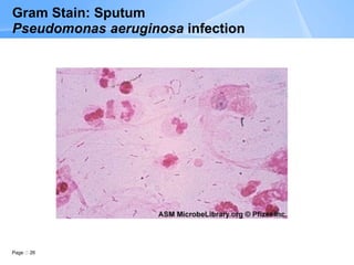 Page 26
Gram Stain: Sputum
Pseudomonas aeruginosa infection
 