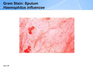 Page 27
Page  27
Gram Stain: Sputum
Haemophilus influenzae
 