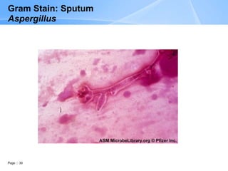 Page 30
Gram Stain: Sputum
Aspergillus
 