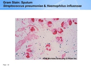 Page 32
Gram Stain: Sputum
Streptococcus pneumoniae & Haemophilus influenzae
 