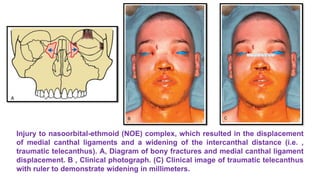 Lecture 1 maxillofacial trauma | PPTX