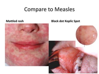 Mmr Rash Comparison So, You're Not Vaccinating. Now What? Session 1: Measles, Mumps ...