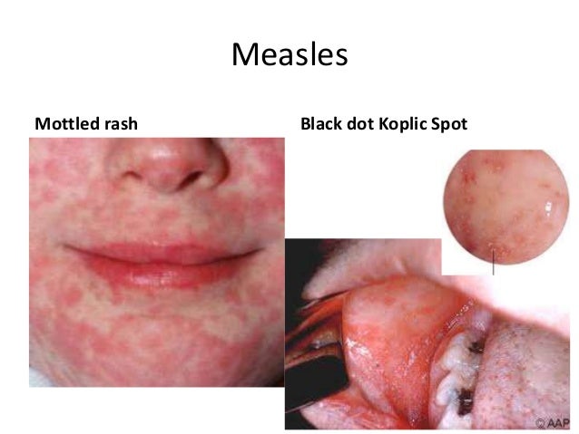 What Does Rubeola (Measles) Look Like? - Healthline